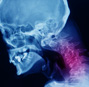 Tangible Interaction Design for Cervical Spondylosis Prevention